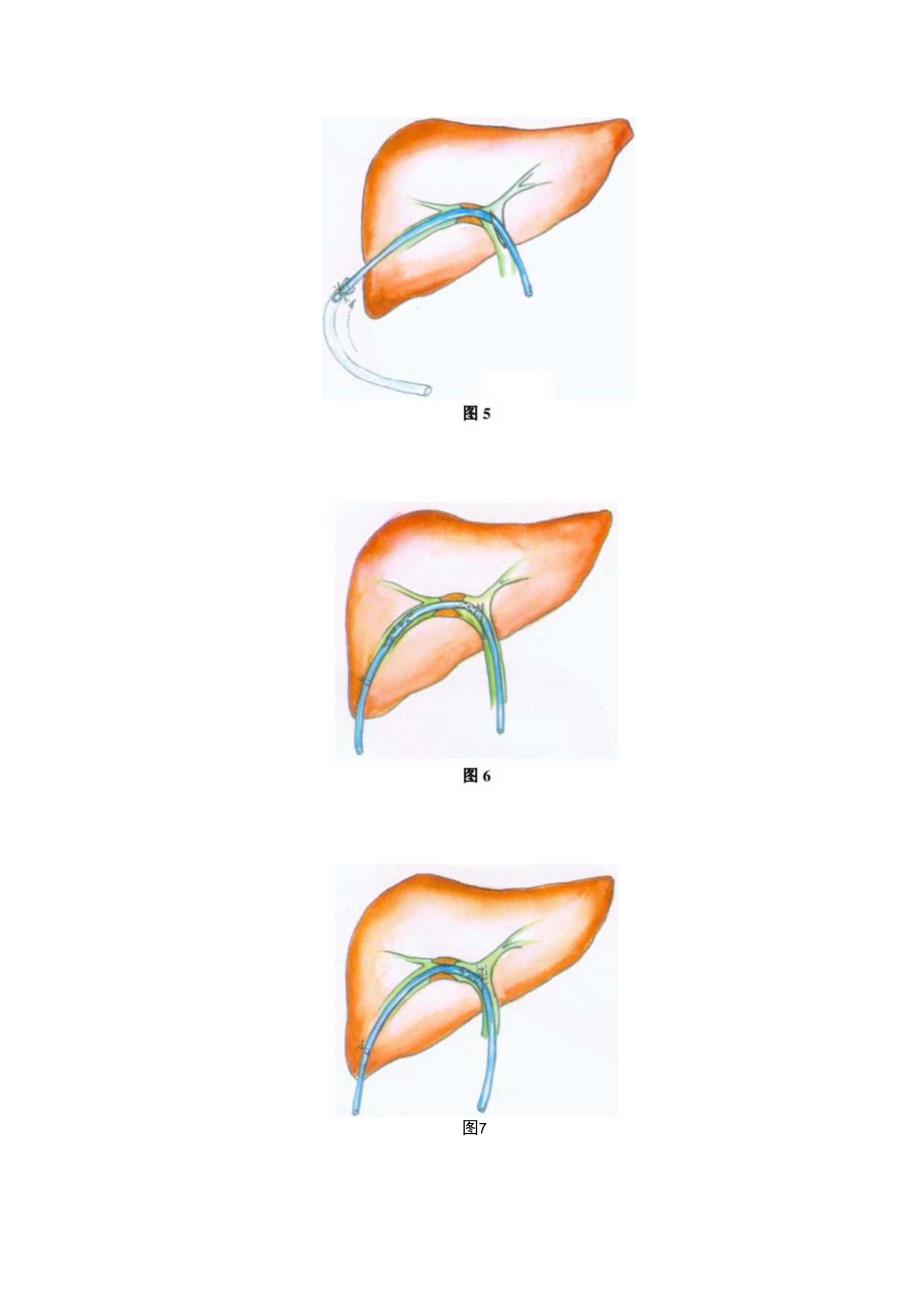 手术图谱资料：U形管引流术.docx_第3页