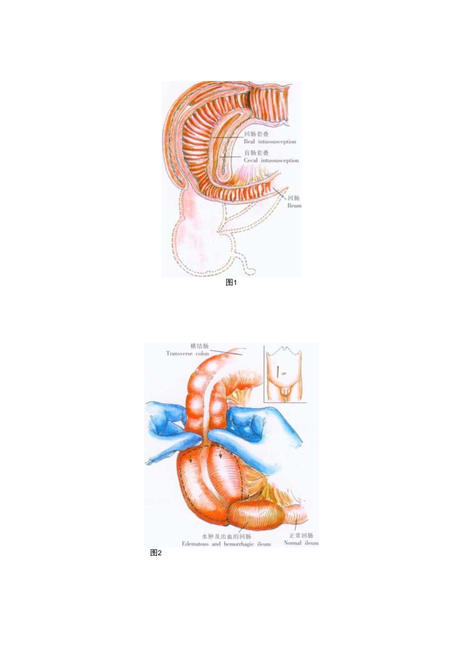 手术图谱资料：肠套叠复位术.docx_第2页