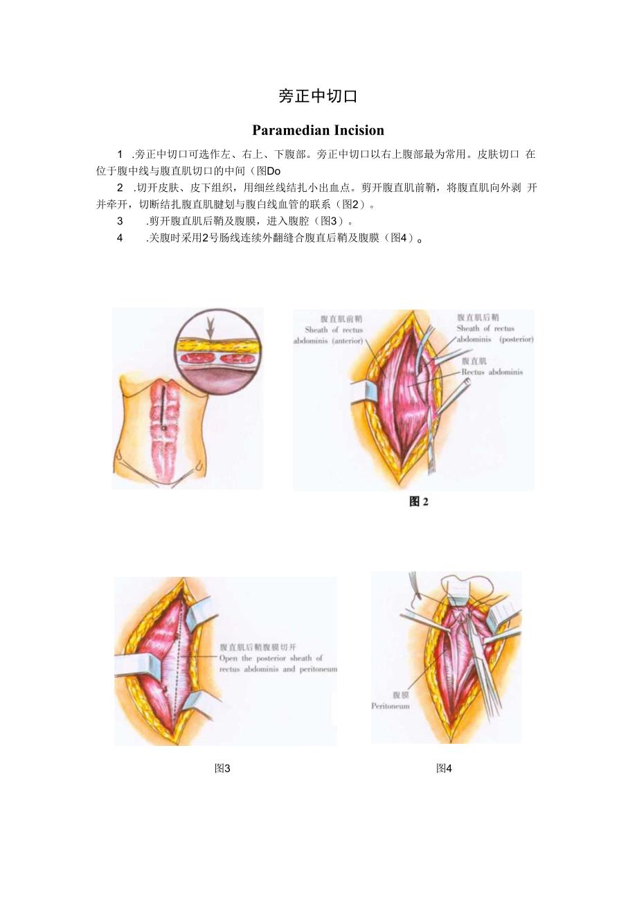 手术图谱资料：旁正中切口.docx_第1页