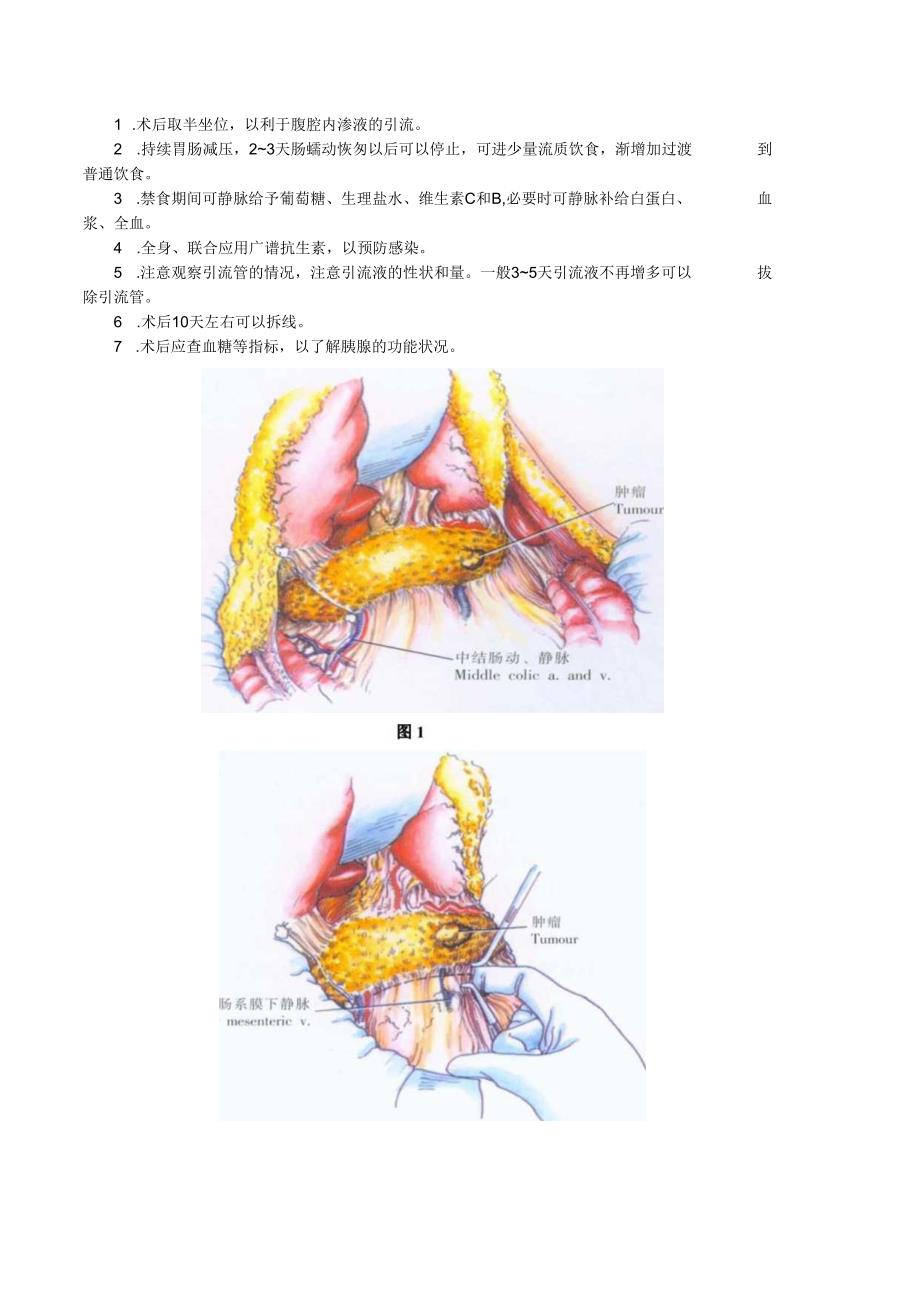 手术图谱资料：胰体、胰尾切除术.docx_第2页