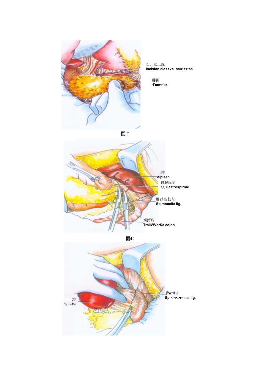 手术图谱资料：胰体、胰尾切除术.docx_第3页