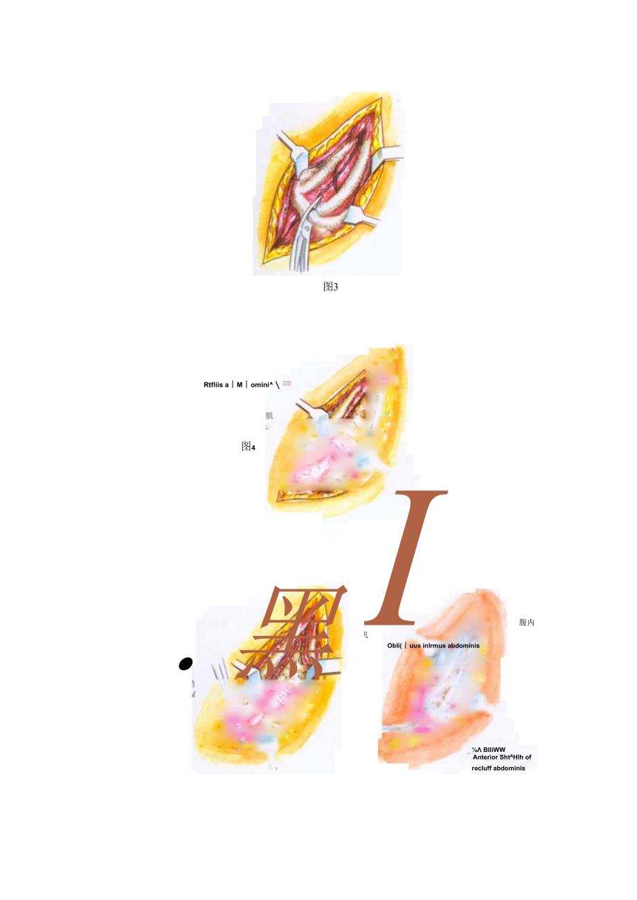 手术图谱资料：胸腹联合切口.docx_第2页