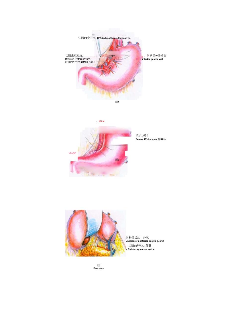 手术图谱资料：经腹胃底静脉断流术.docx_第3页
