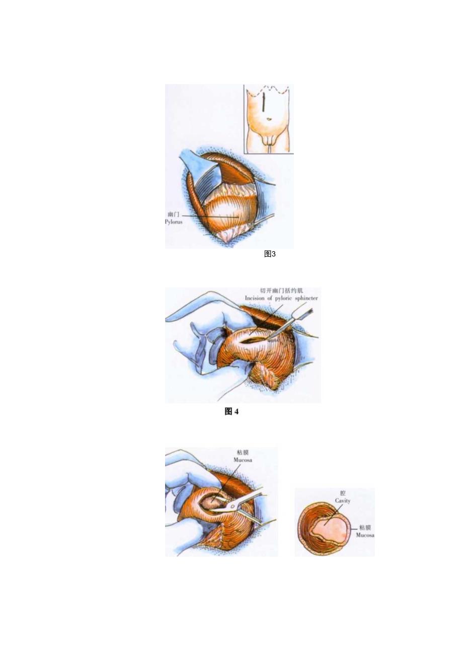 手术图谱资料：幽门括约肌切开术.docx_第2页