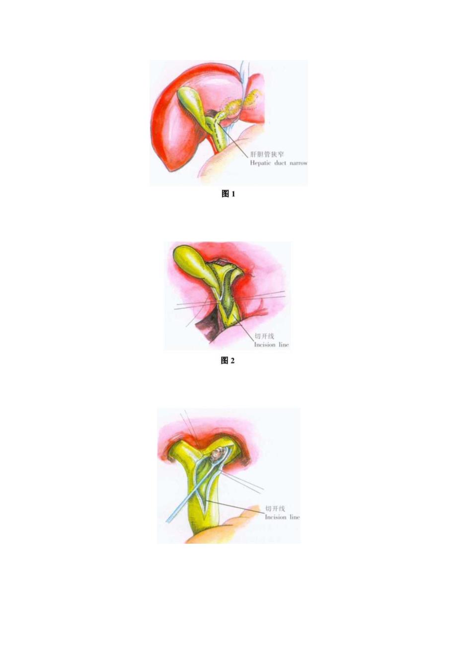 手术图谱资料：肝胆管探查引流术.docx_第2页