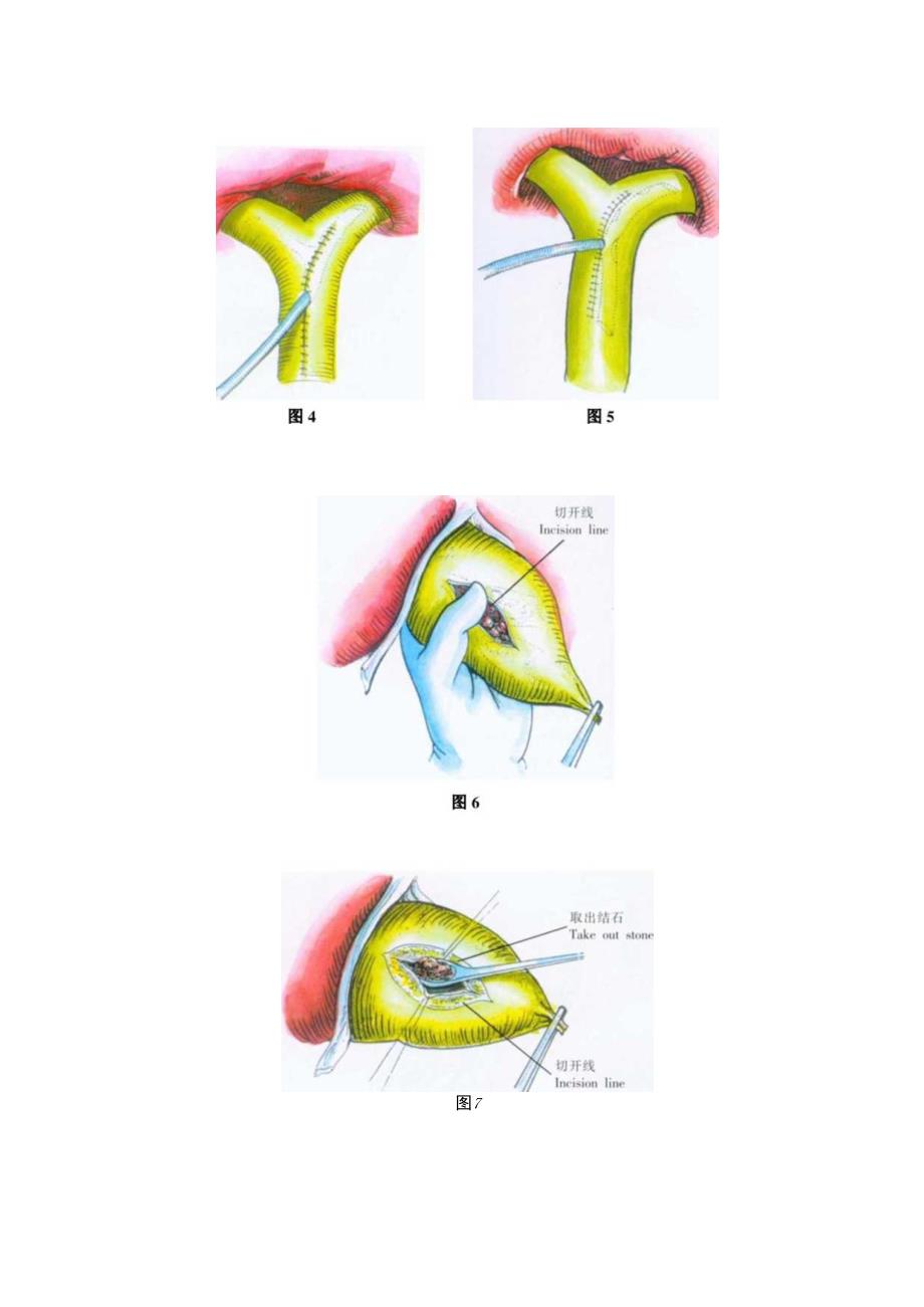 手术图谱资料：肝胆管探查引流术.docx_第3页