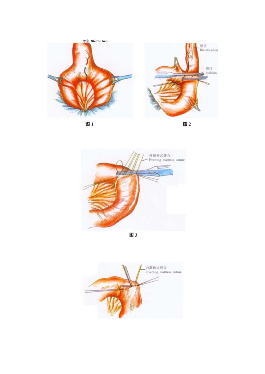 手术图谱资料：Meckel憩室切除术.docx_第2页