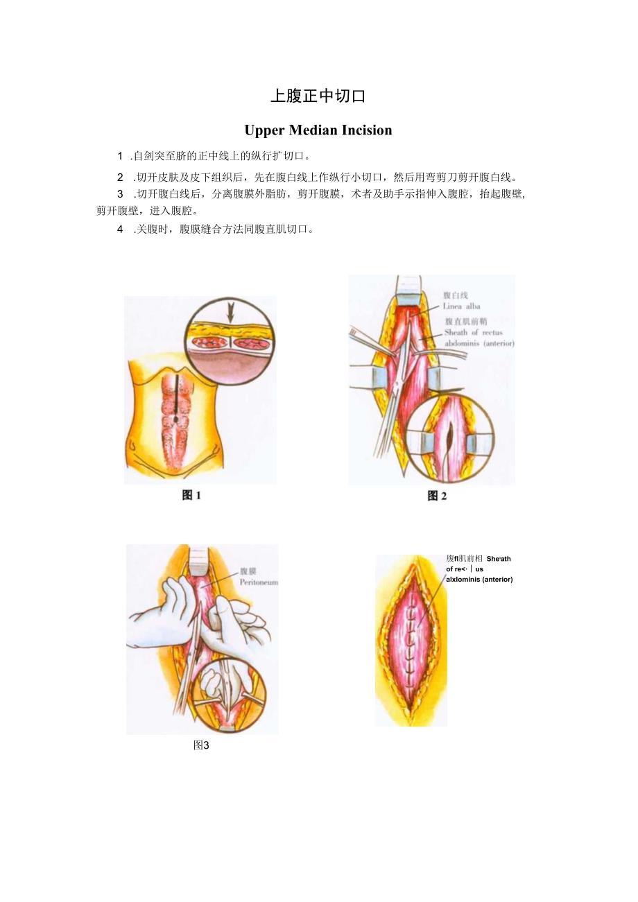 手术图谱资料：上腹正中切口.docx_第1页