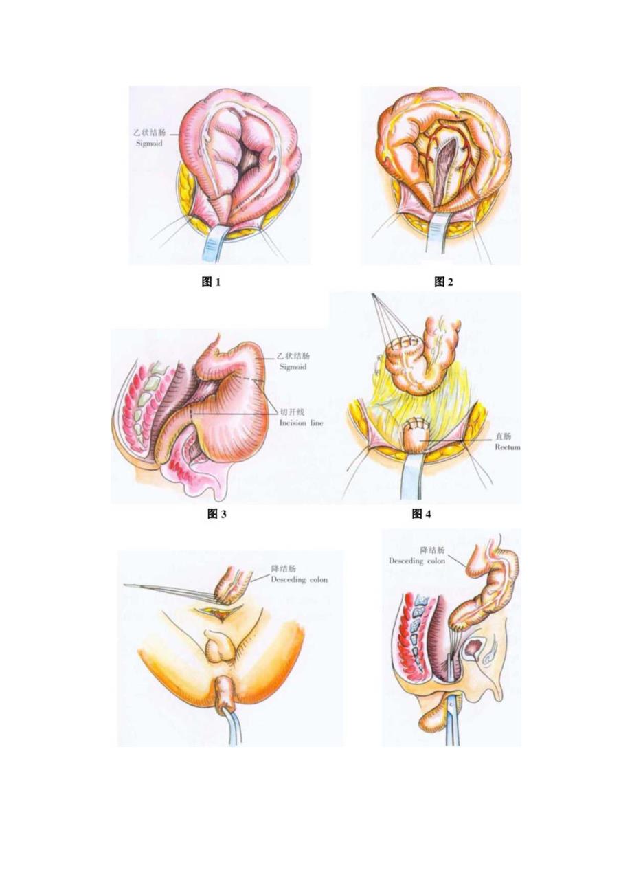 手术图谱资料：Swenson结直肠拉出切除术.docx_第2页