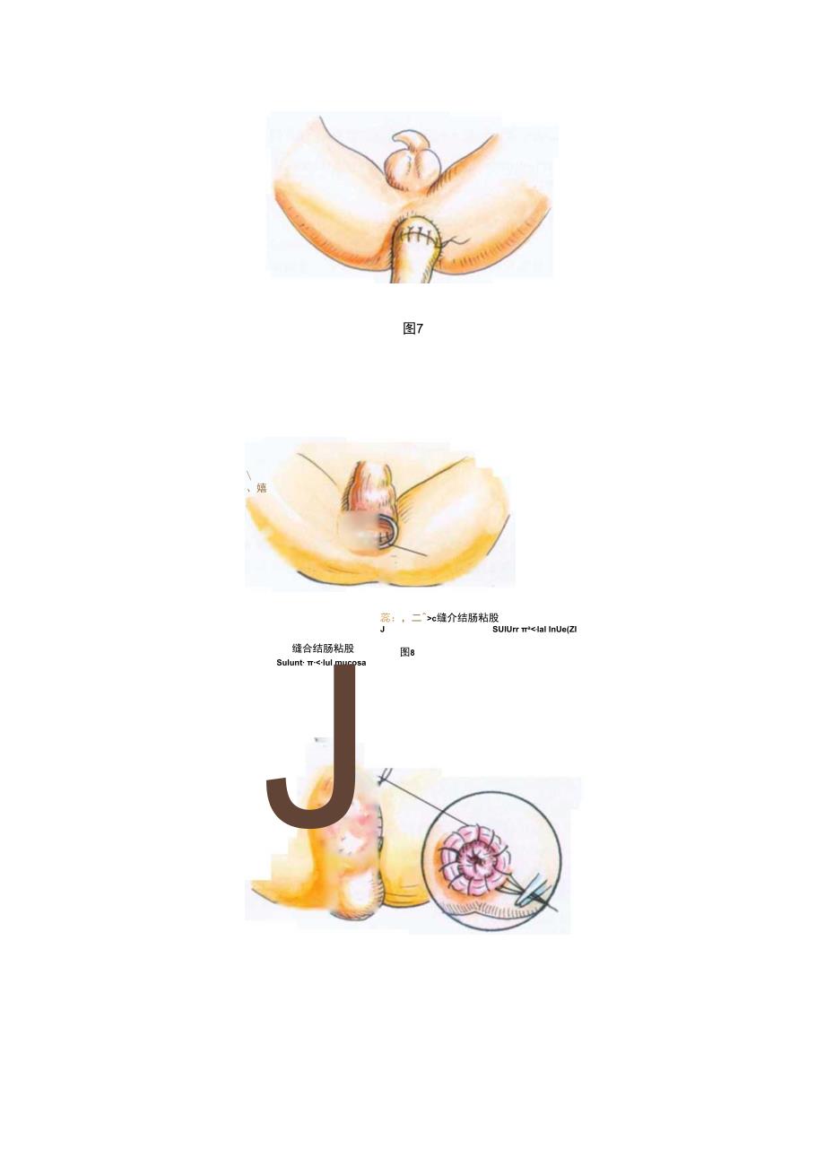 手术图谱资料：Swenson结直肠拉出切除术.docx_第3页