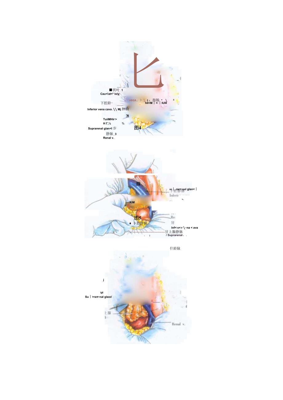 手术图谱资料：双侧肾上腺切除术.docx_第3页