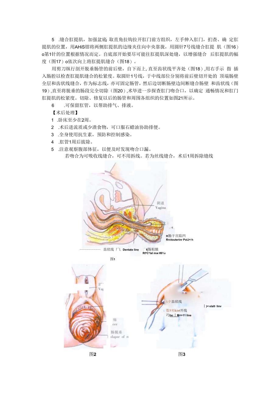 手术图谱资料：直肠脱垂经会阴修复术.docx_第3页