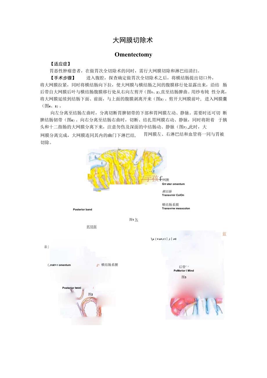 手术图谱资料：大网膜切除术.docx_第1页