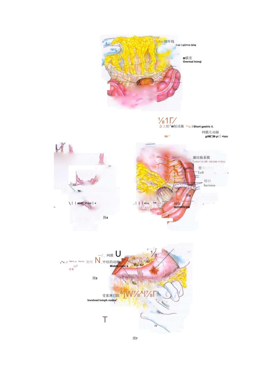 手术图谱资料：大网膜切除术.docx_第2页
