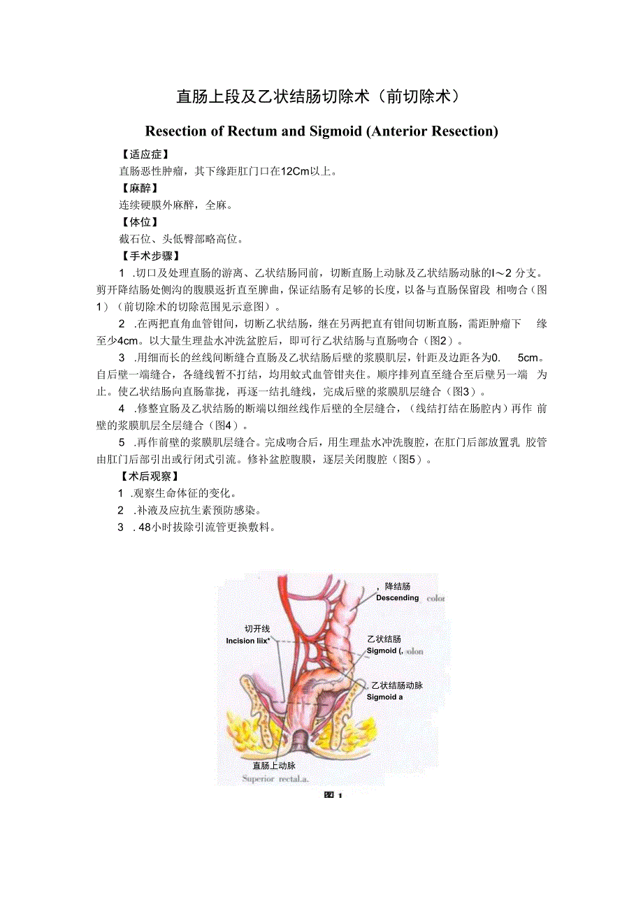 手术图谱资料：直肠上段及乙状结肠切除术(前切除术).docx_第1页