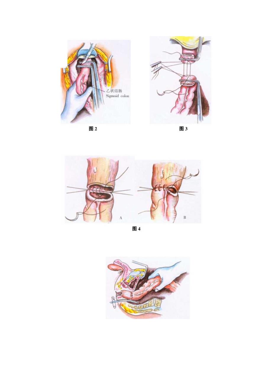 手术图谱资料：直肠上段及乙状结肠切除术(前切除术).docx_第2页