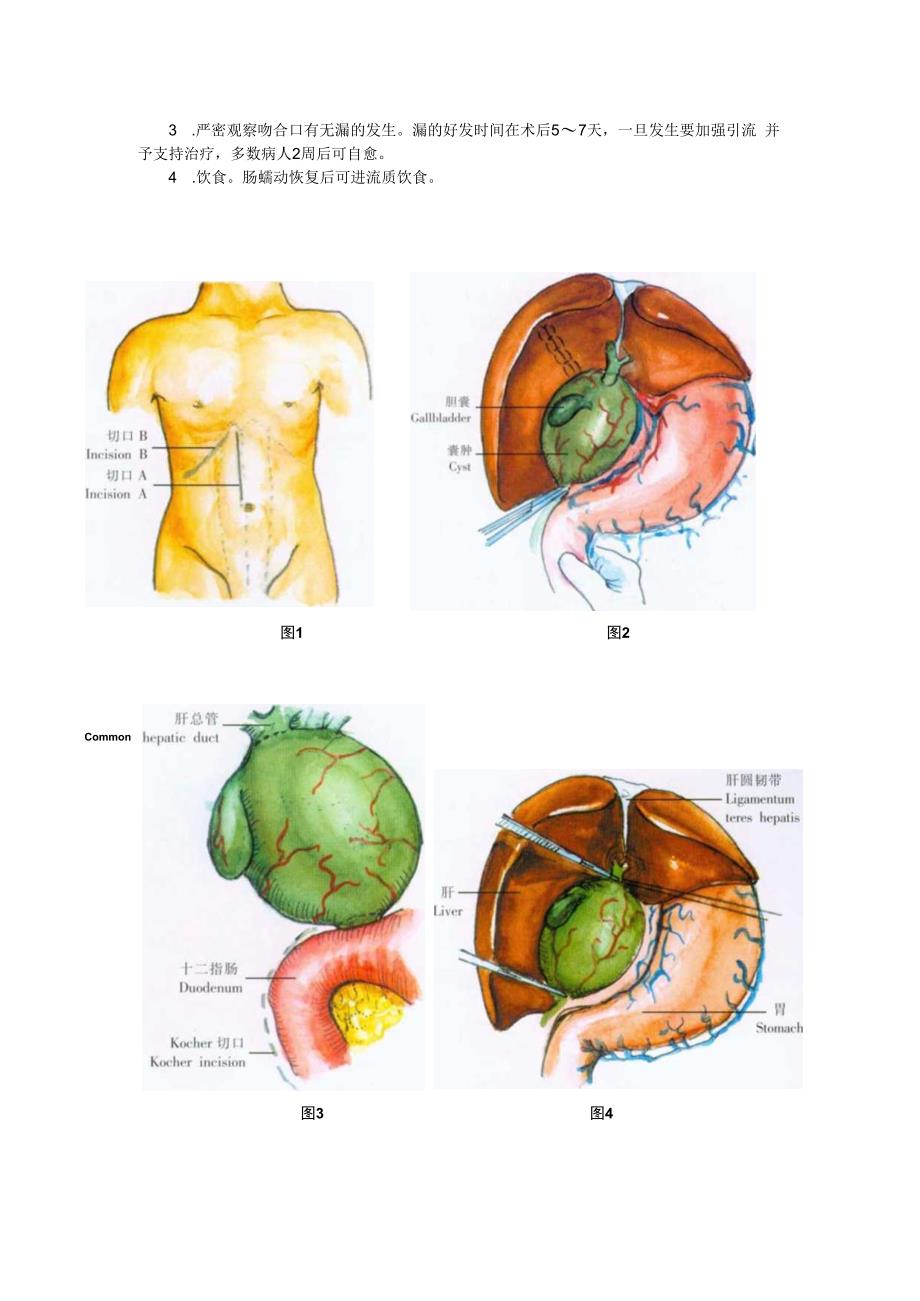 手术图谱资料：先天性胆总管囊肿切除术.docx_第3页