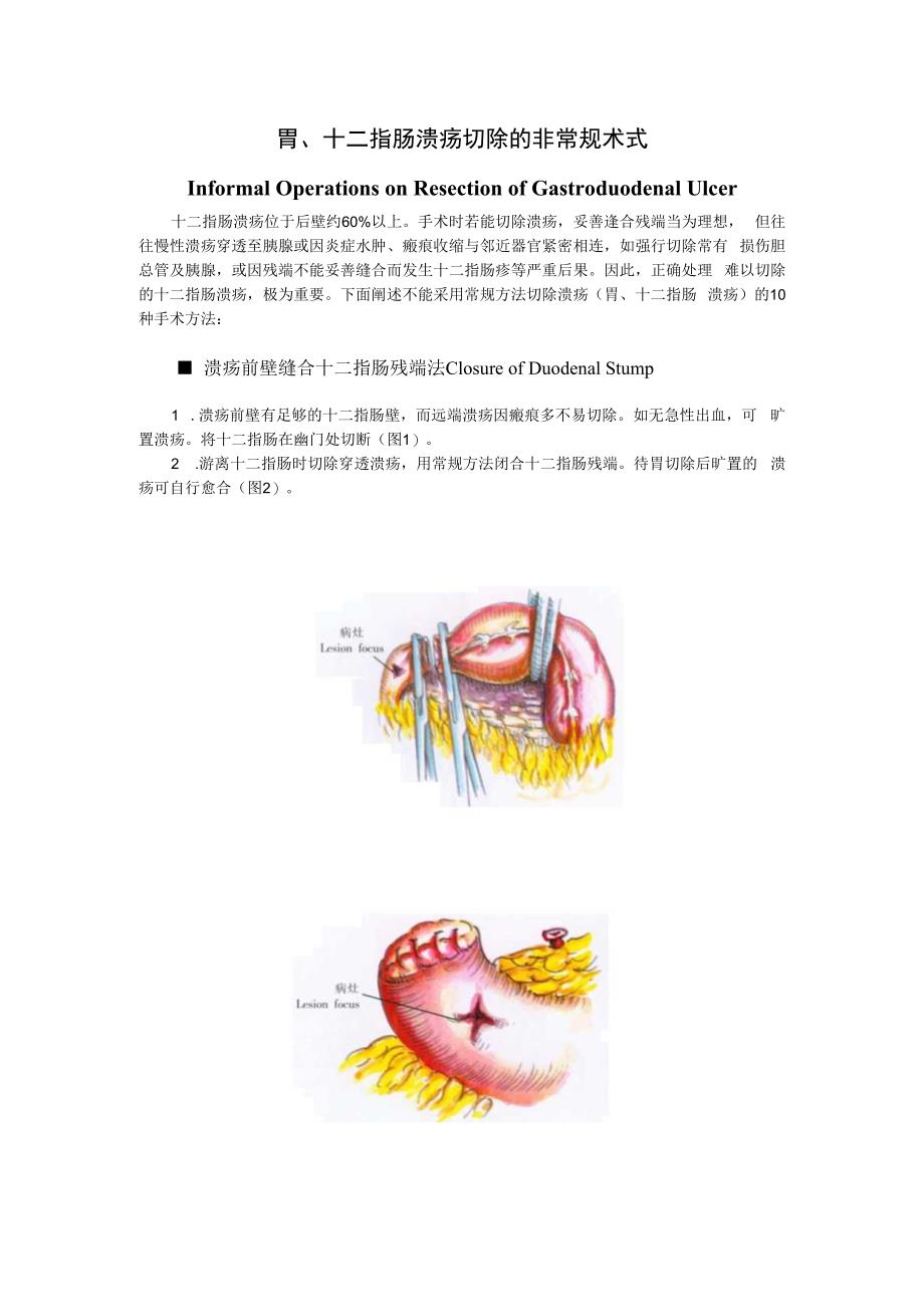 手术图谱资料：胃、十二指肠溃疡切除的非常规术式.docx_第1页