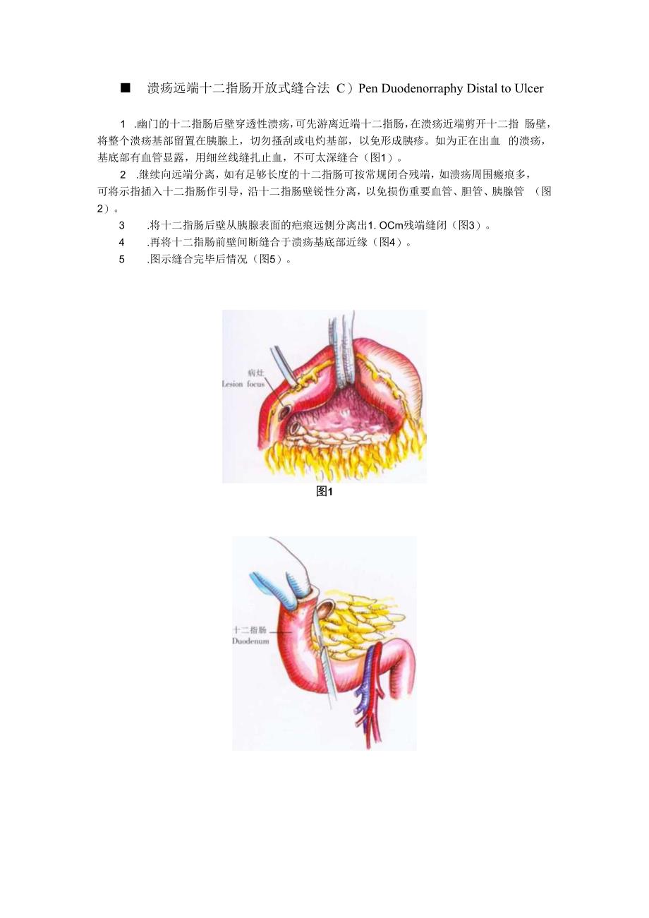 手术图谱资料：胃、十二指肠溃疡切除的非常规术式.docx_第2页