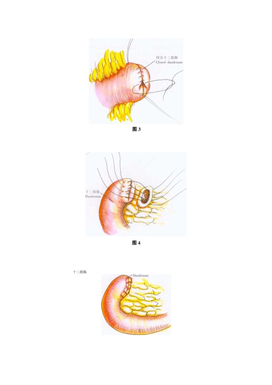 手术图谱资料：胃、十二指肠溃疡切除的非常规术式.docx_第3页