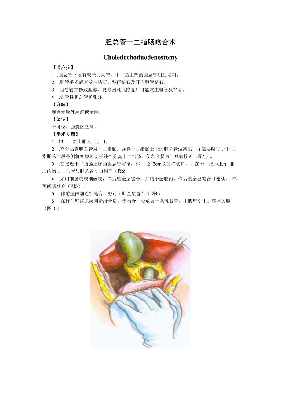 手术图谱资料：胆总管十二指肠吻合术.docx_第1页