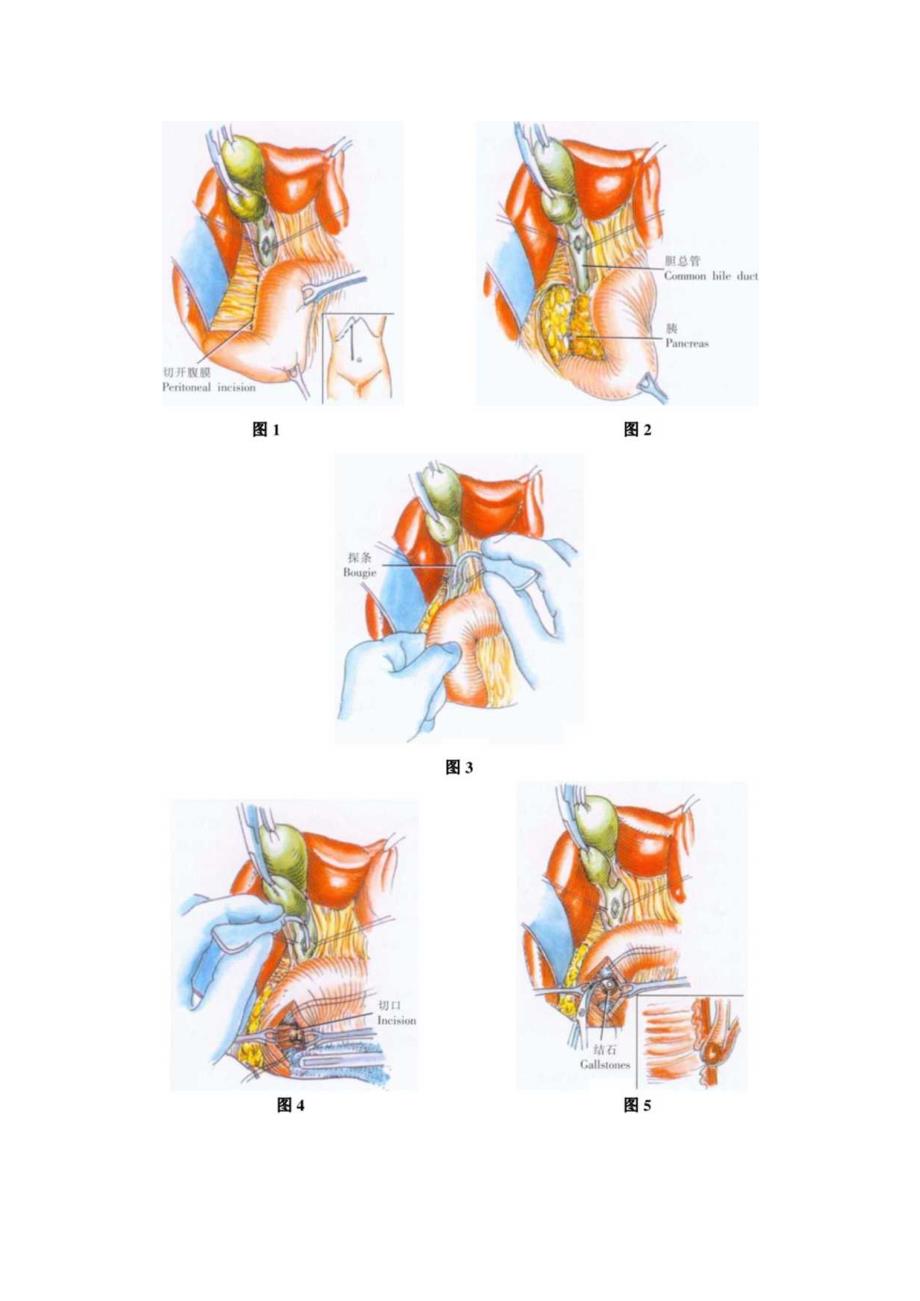 手术图谱资料：Oddi括约肌切除术和成形术.docx_第2页