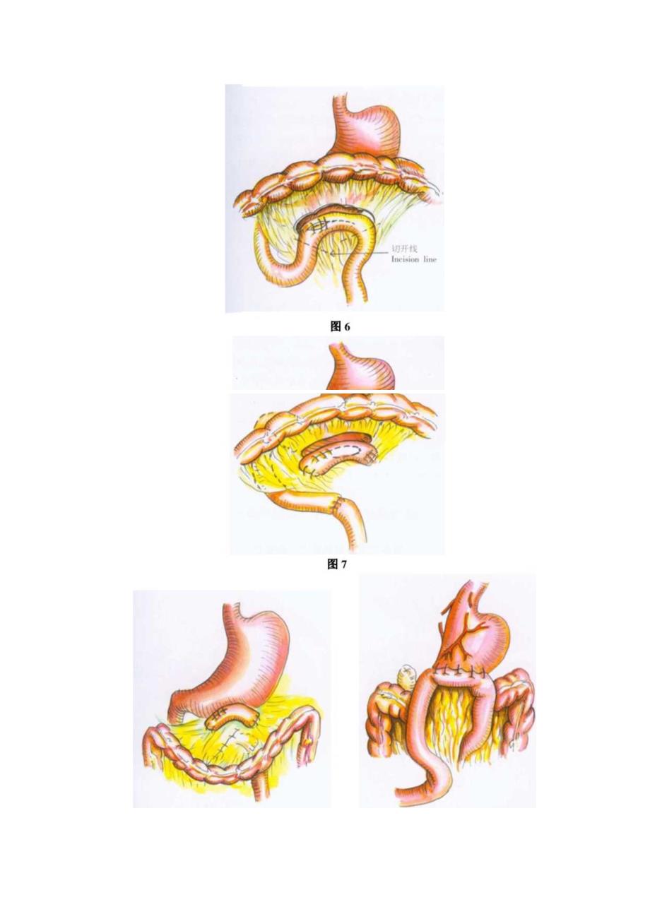 手术图谱资料：胃大部切除术后合并胃空肠结肠瘘.docx_第3页