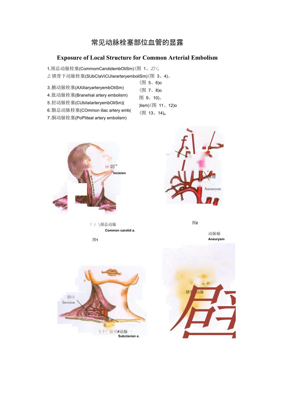 手术图谱资料：常见动脉栓塞部位血管的显露.docx_第1页