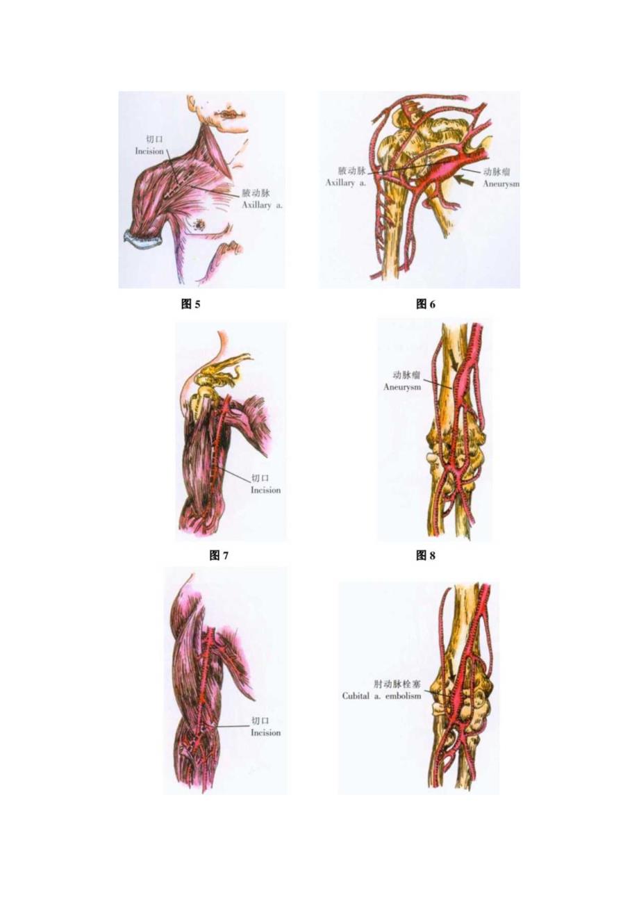 手术图谱资料：常见动脉栓塞部位血管的显露.docx_第2页