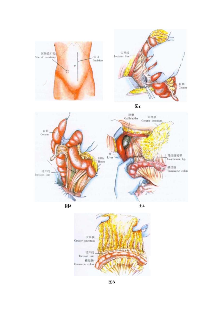 手术图谱资料：结肠全切除术.docx_第3页