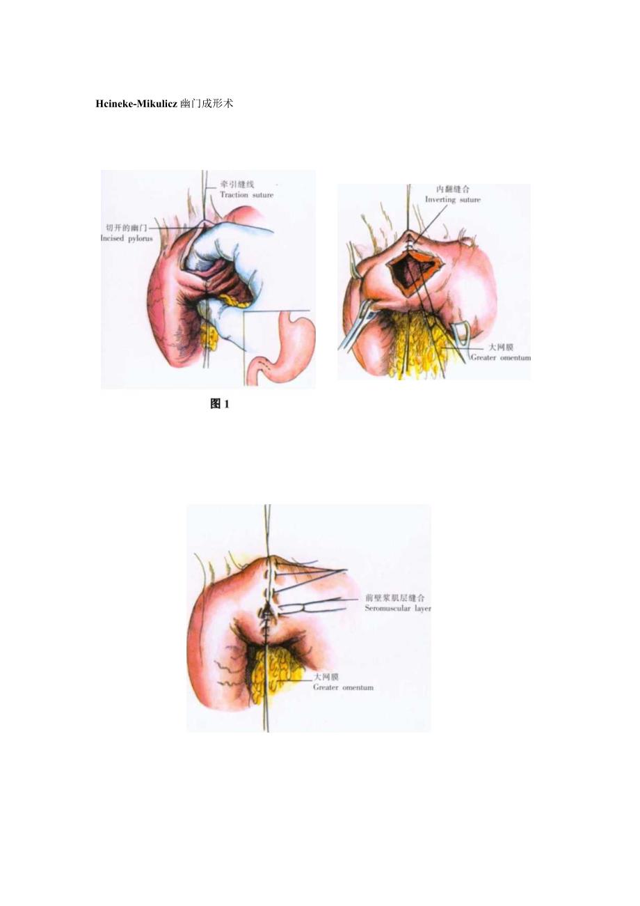 手术图谱资料：幽门成形术和胃十二指肠吻合术.docx_第2页