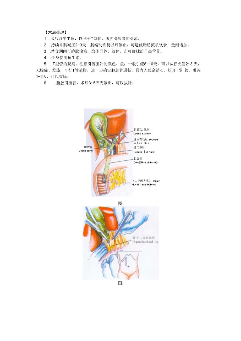 手术图谱资料：胆总管探查和引流术.docx_第3页