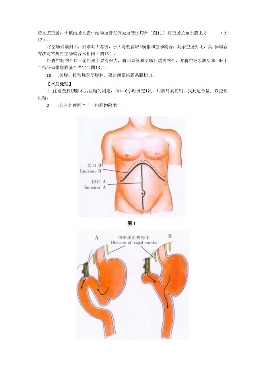 手术图谱资料：胰腺全切除术.docx_第3页