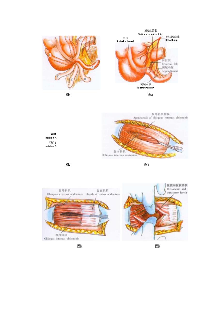 手术图谱资料：阑尾切除术.docx_第3页