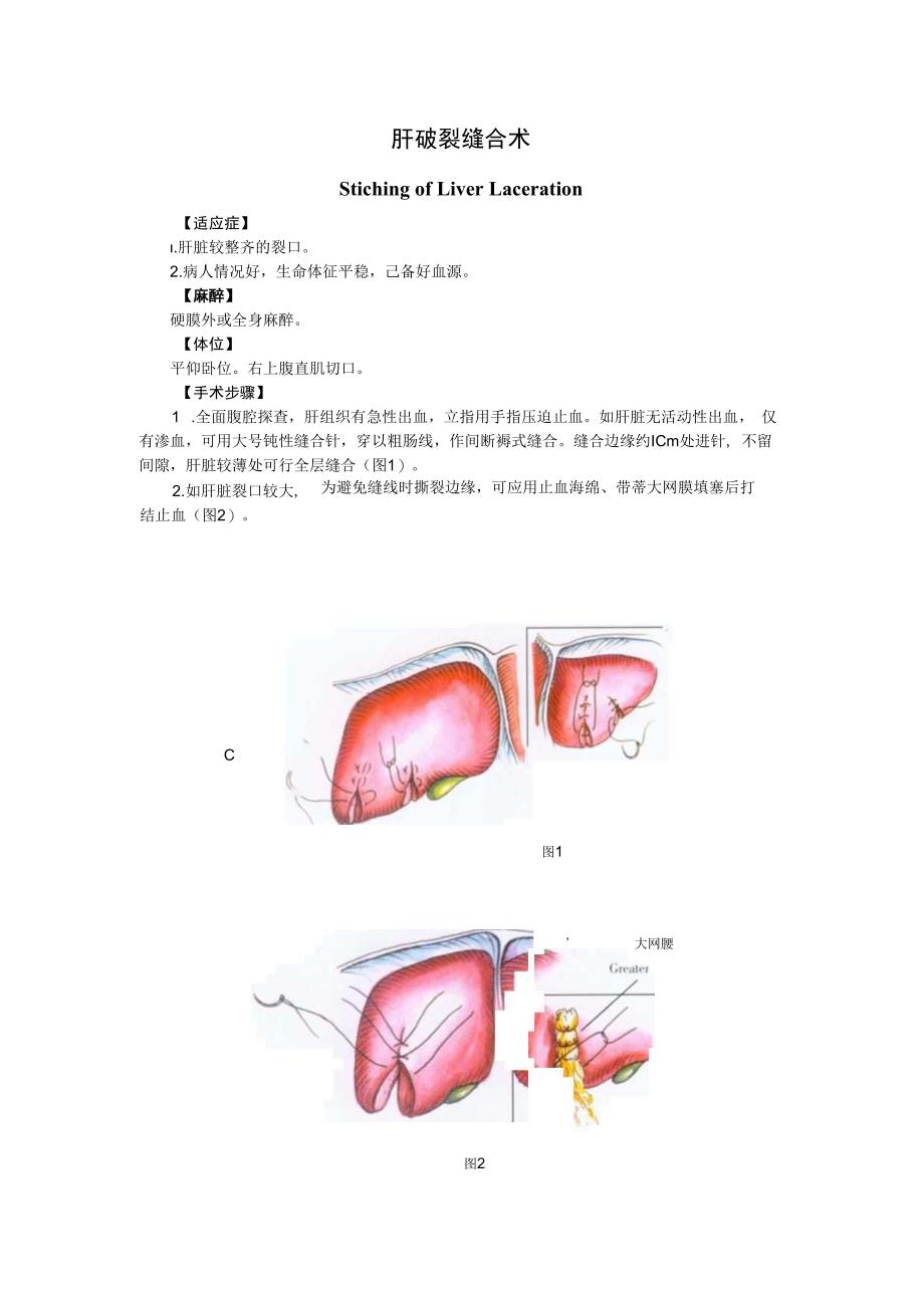 手术图谱资料：肝破裂缝合术.docx_第1页