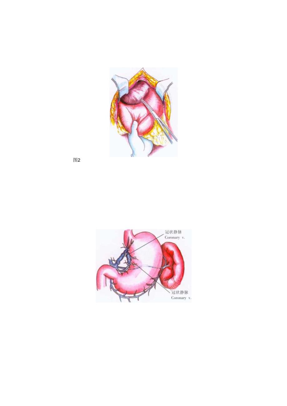 手术图谱资料：胃冠状静脉结扎术.docx_第2页