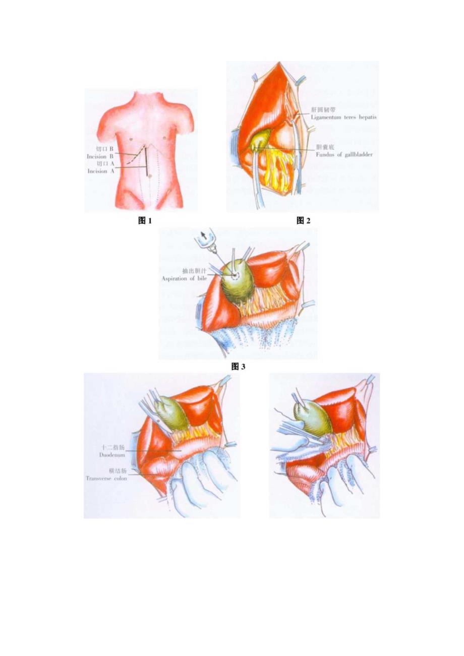 手术图谱资料：胆囊切除术.docx_第3页