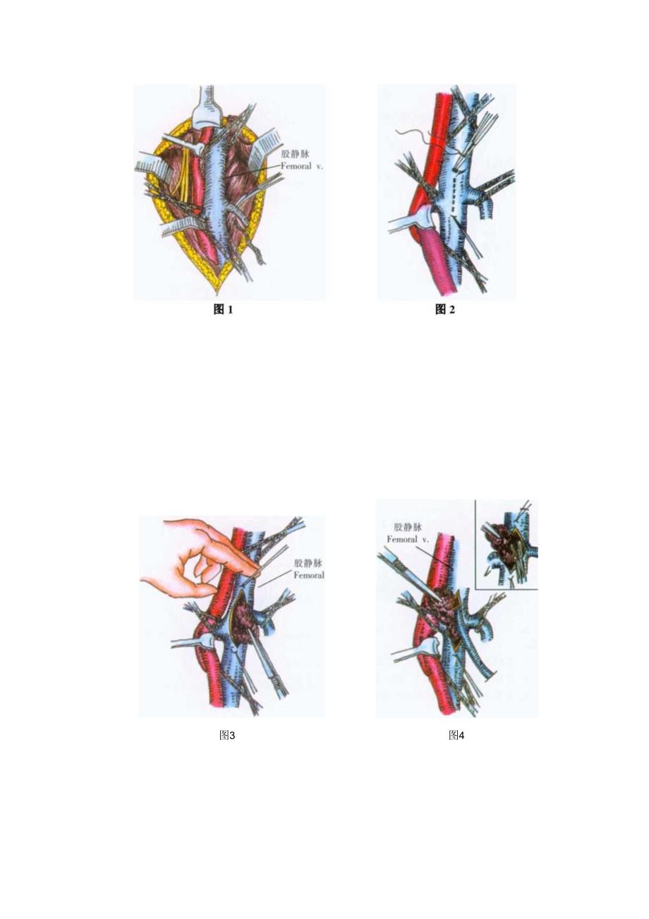 手术图谱资料：髂股静脉血栓取出术.docx_第2页