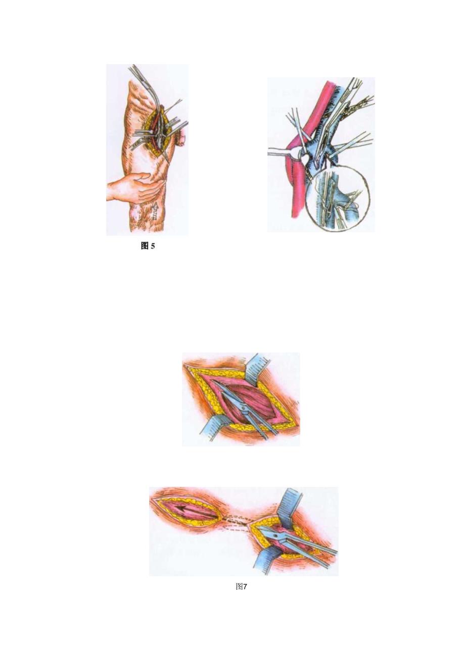 手术图谱资料：髂股静脉血栓取出术.docx_第3页