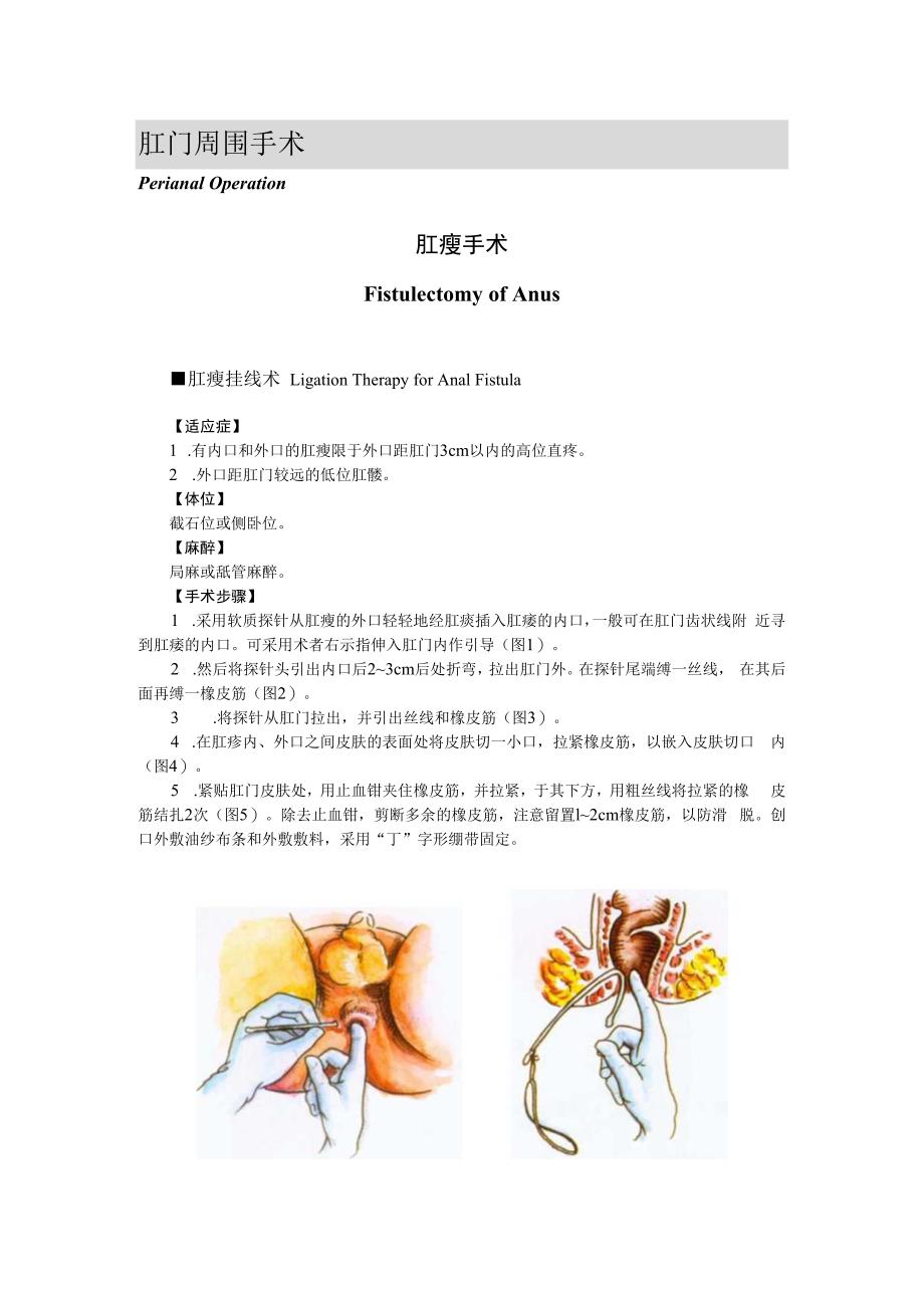 手术图谱资料：肛瘘手术.docx_第1页