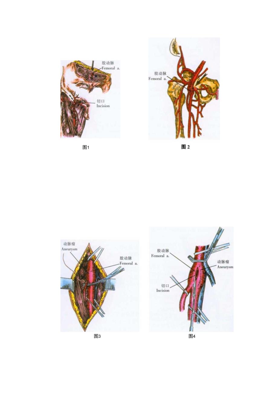 手术图谱资料：股动脉栓子取出术.docx_第2页