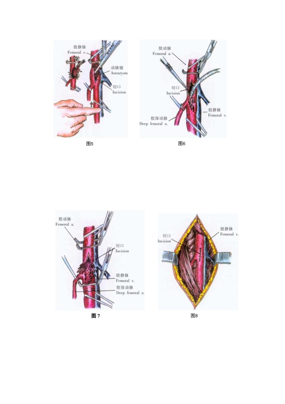 手术图谱资料：股动脉栓子取出术.docx_第3页