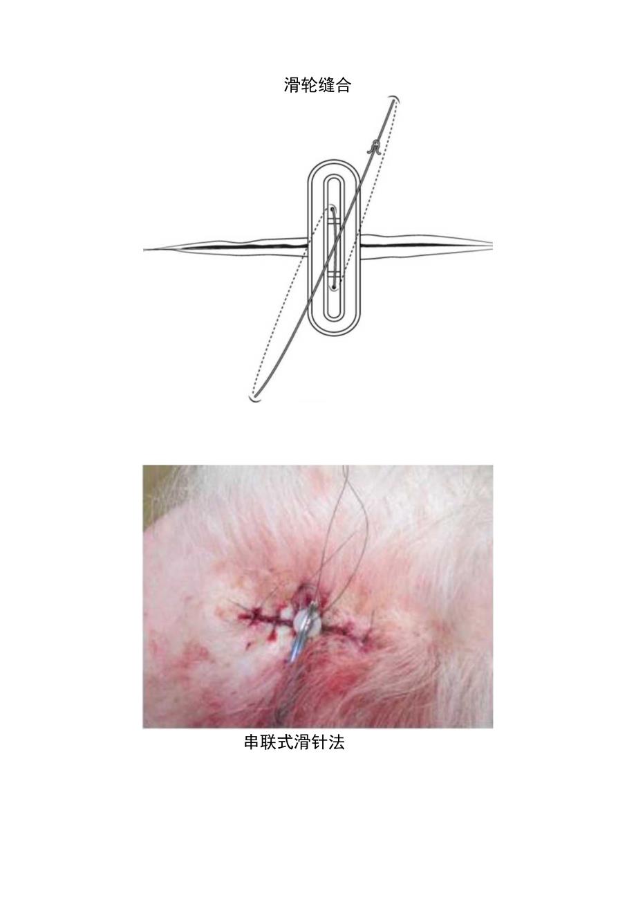 章氏超减张缝合、双蝶形缝合、滑轮缝合、串联式滑针法等高张力切口缝合方法操作注意事项.docx_第2页