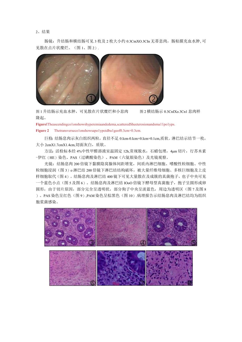 结肠及淋巴结组织胞浆菌病1例并文献复习.docx_第2页