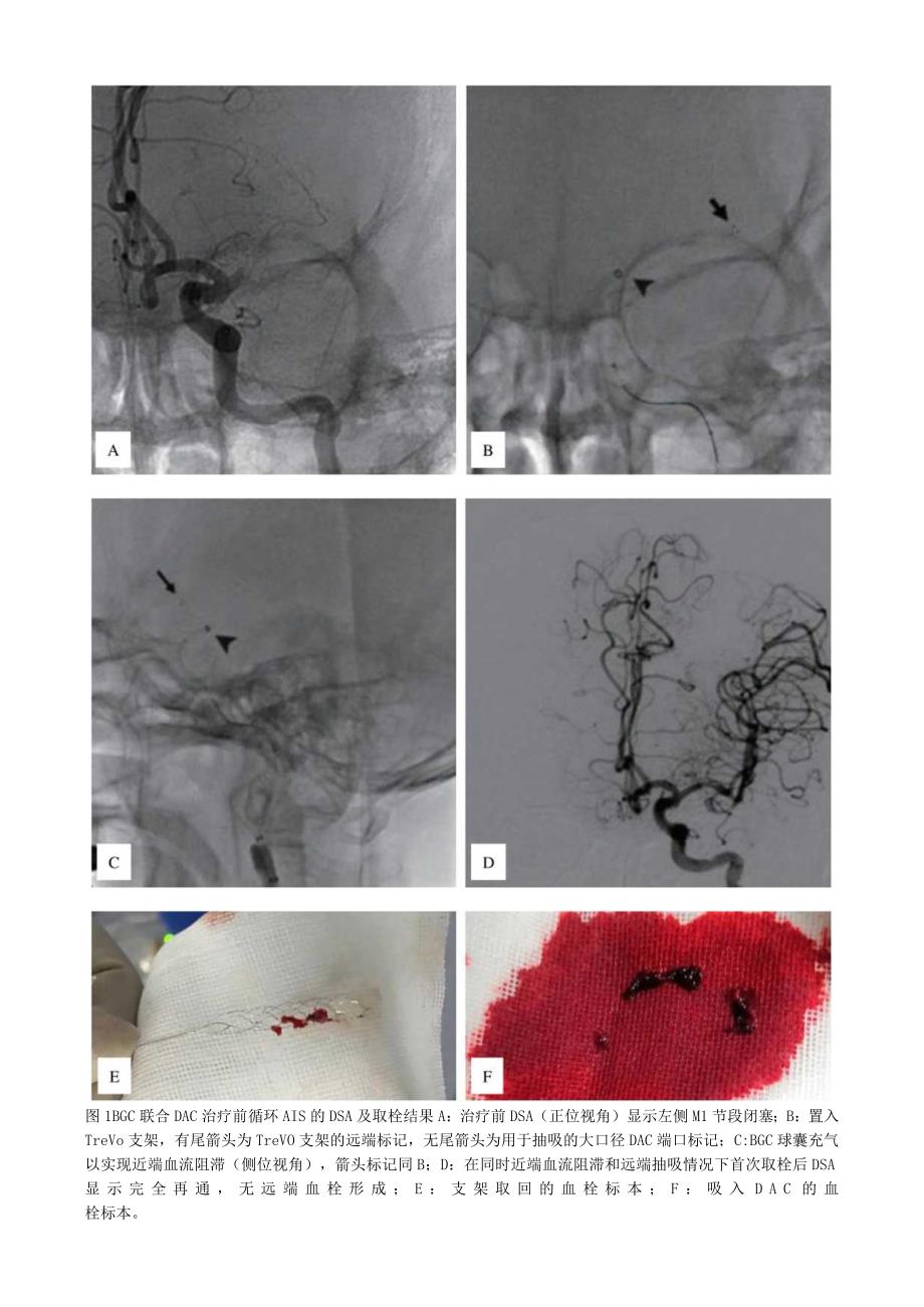 近端球囊导引导管与远端通路导管联合治疗前循环急性缺血性脑卒中的疗效分析.docx_第3页