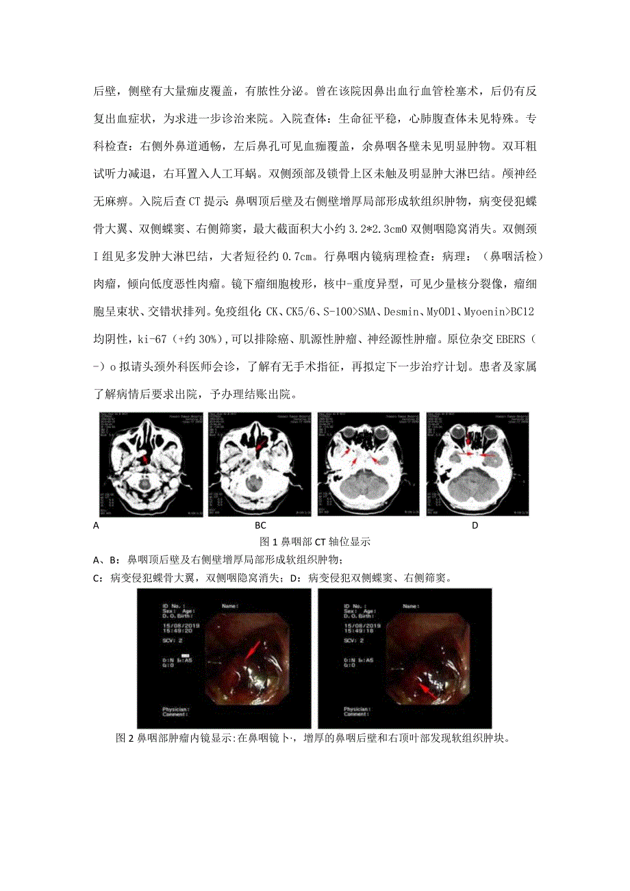 鼻咽癌放疗后诱发肉瘤1例并文献复习.docx_第2页