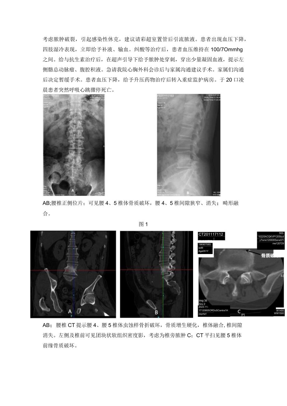 腰椎结核合并假性动脉瘤一例报道并文献复习.docx_第2页