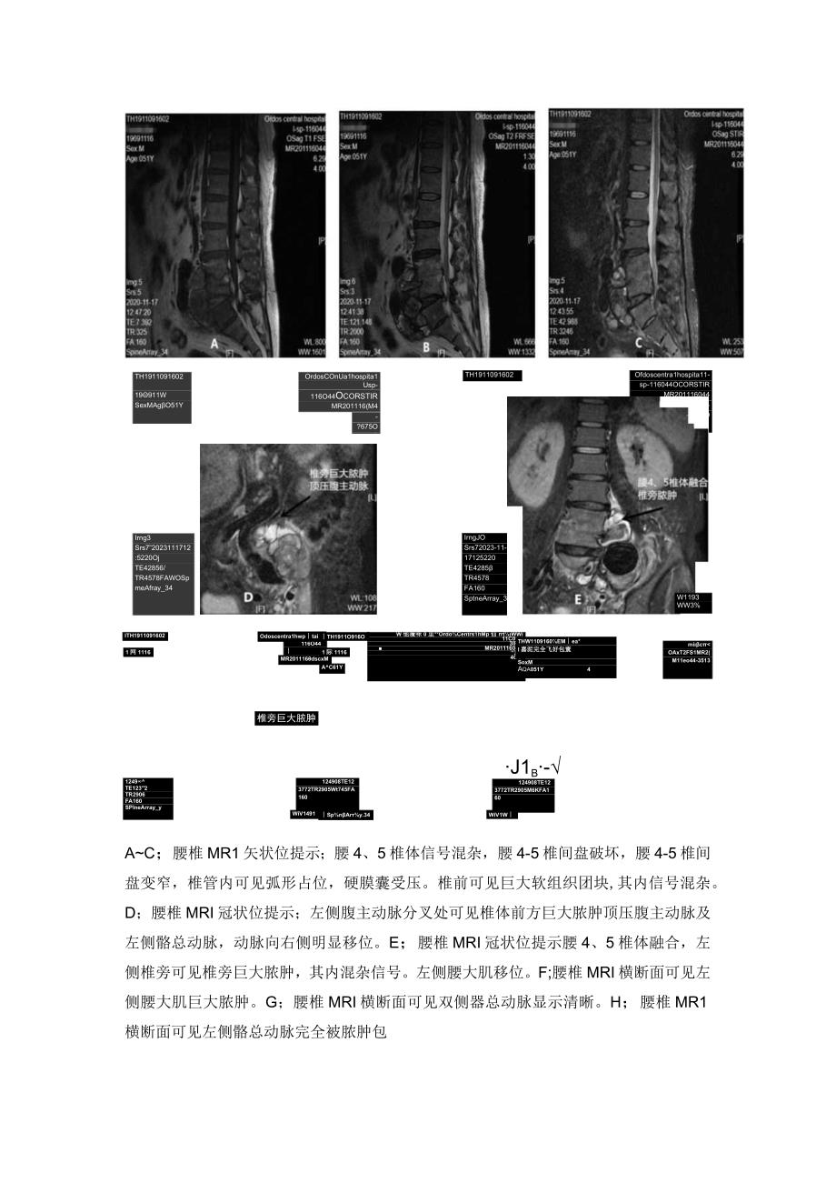 腰椎结核合并假性动脉瘤一例报道并文献复习.docx_第3页