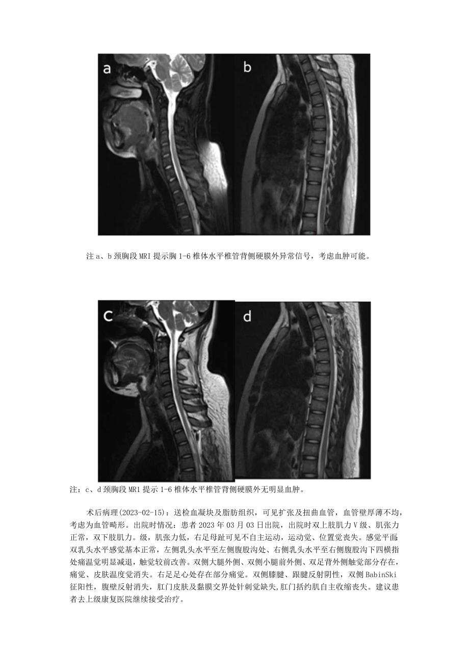 青少年胸椎段急性自发性硬脊膜外血肿1列并文献复习.docx_第3页