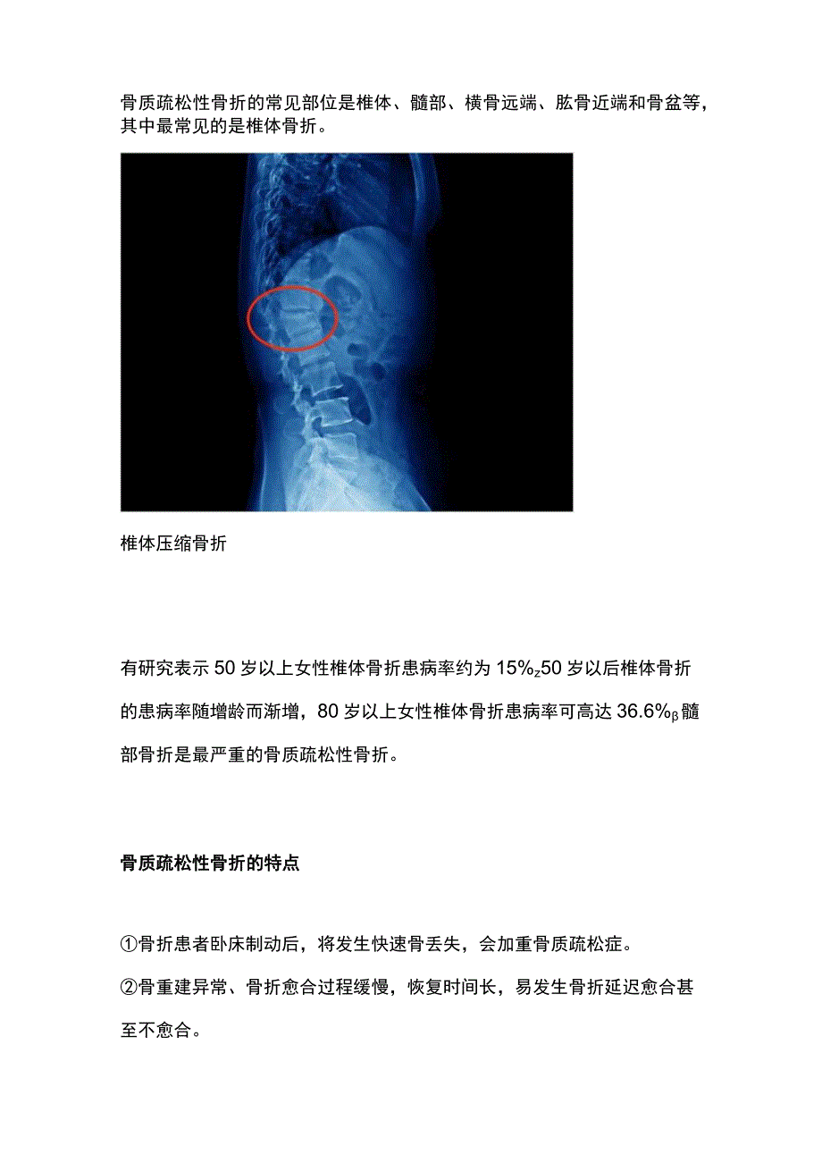 2023骨质疏松性骨折：诊断、治疗和康复.docx_第2页